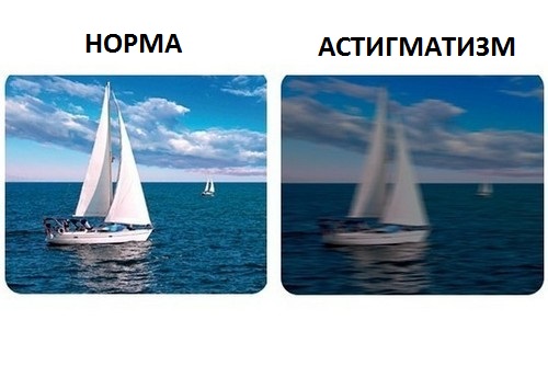 Симптомы и лечение астигматизма высокой степени. диагностика и профилактика астигматизма современной клинике