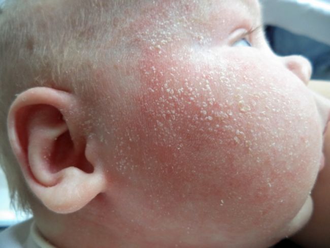 Шелушение кожи у новорожденных