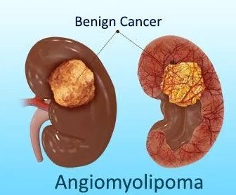 Ангиомиолипома почки: диагностика и лечение