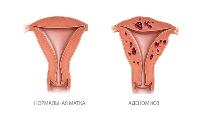 Аденомиоз: в чем опасность и нужно ли лечить?