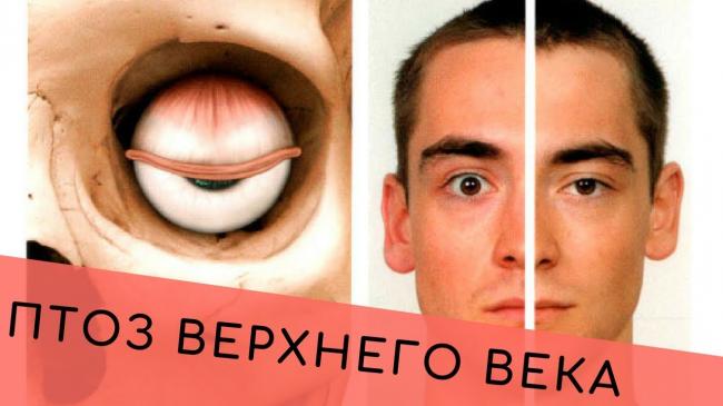 Птоз верхнего века: виды птоза, псевдоптоз, лечение | портал 1nep.ru