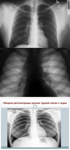 Как выглядит пневмония на снимке