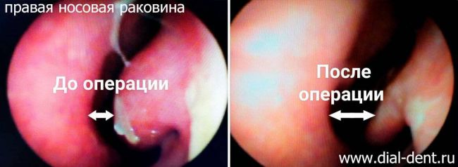 Вазомоторный ринит: симптомы и лечение