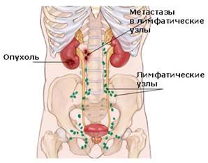 Эффективное лечение рака 4 стадии (метастазы, канцероматоз, асцит)