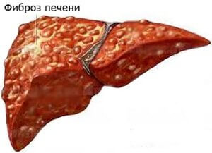 Классификация фиброза печени: определение, его патологические процессы, обратимость и диагностика.