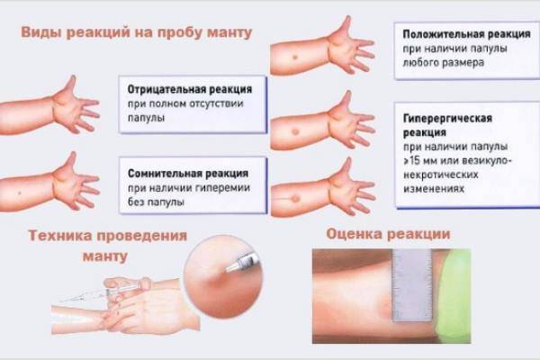 Papula-mantu - запись пользователя леля (id989355) в сообществе детские болезни от года до трех в категории прививки - babyblog.ru