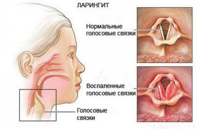 Першит в горле и хочется кашлять: чем лечить? что делать?