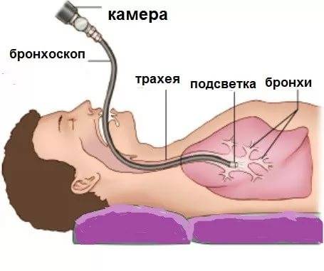 Мокрота с кровью при кашле по утрам