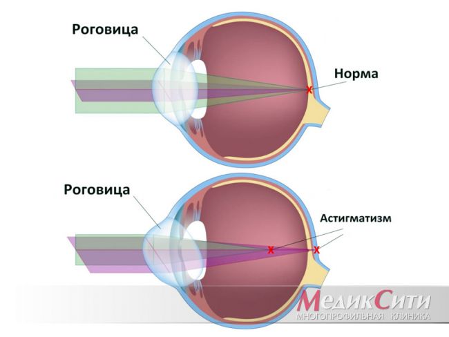 Виды близорукого астигматизма и способы их лечения