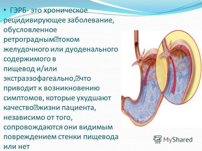 Гастроэзофагеальная рефлюксная болезнь желудка (гэрб): классификация, симптомы, лечение и питание при заболевании