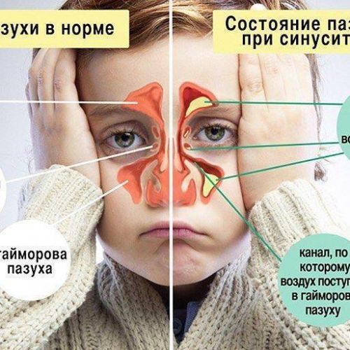 Гайморовы пазухи носа: причины воспаления. лечение
