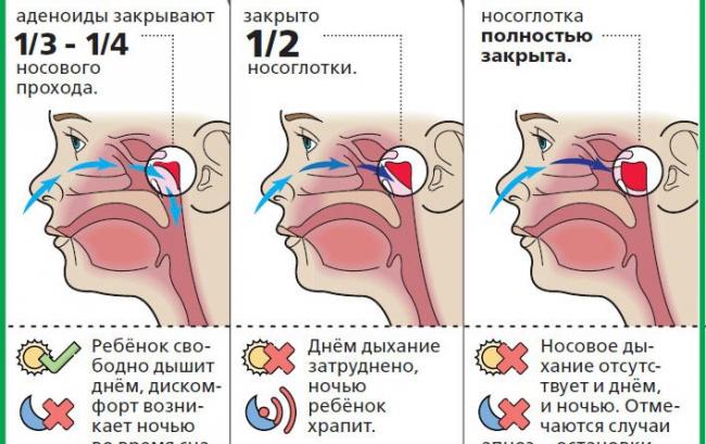 Масло туи для детей и его применение при аденоидите
