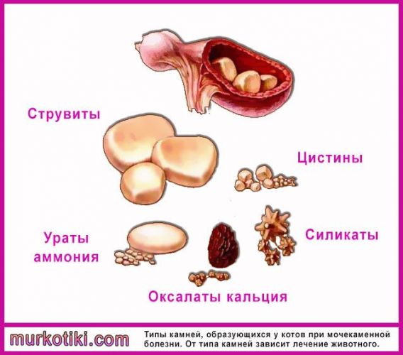 Почему в почках образуются камни и как от них избавиться