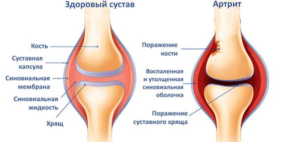 Синовит тазобедренного сустава у детей и взрослых: симптомы и лечение