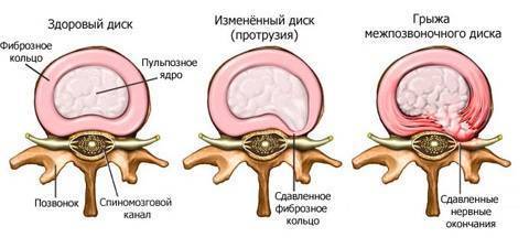 Сколько дней температура при остеохондрозе?