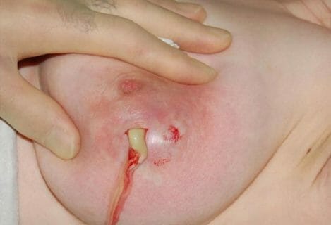 Мастит – первые признаки, симптомы, лечение и профилактика мастита