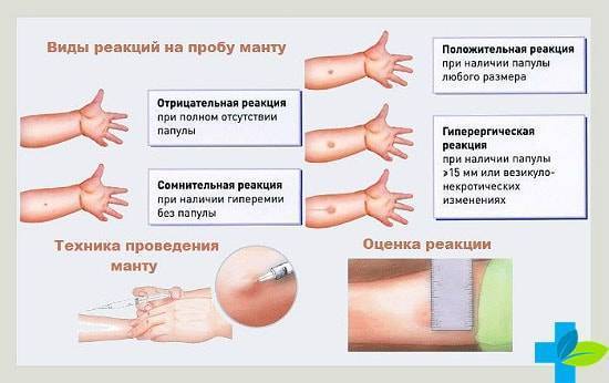 Противопоказания к манту как абсолютные, так и относительные у детей