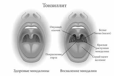 Лечение хронического тонзиллита дома, как лечить пробки в миндалинах в домашних условиях
