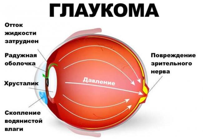 Воспаление верхнего века лечение в домашних условиях