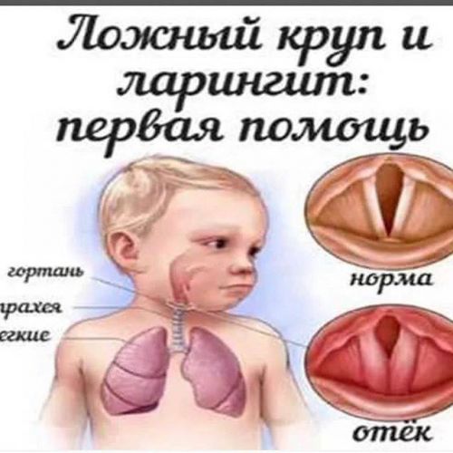 Первая помощь при ложном крупе у детей, симптомы болезни и методы ее лечения