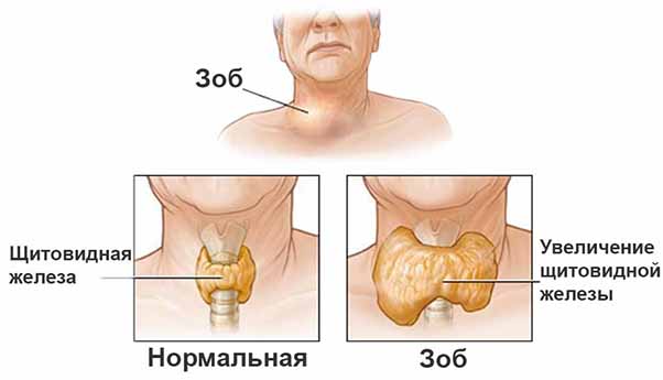 Щитовидная железа или расшатанные нервы? симптомы и лечение гипотиреоза, тиреотоксикоза. гормональный сбой