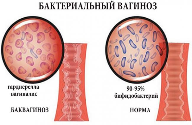 Все о бактериальном вагинозе и его лечении