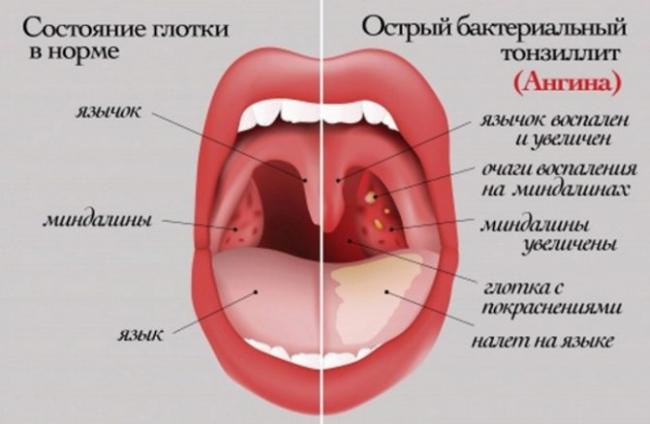 Горло болит чем лечить: статья: у ребенка болит горло: чем лечить