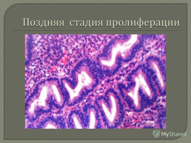Гиперплазия эндометрия в постменопаузе