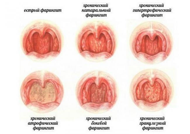 Заболевания горла и гортани: симптомы и лечение болезни