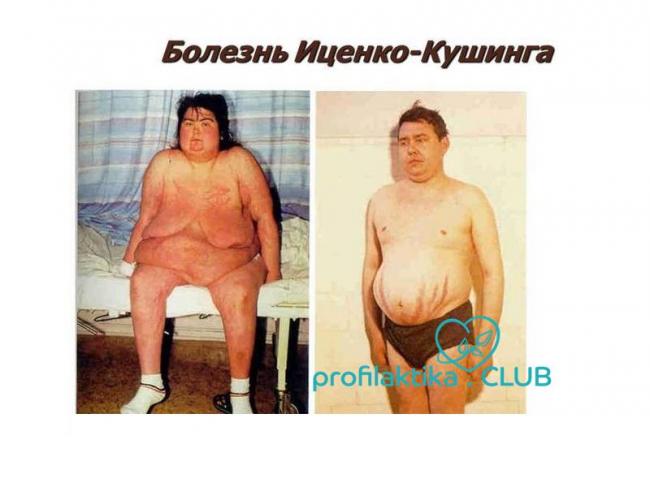 Синдром кушинга (болезнь иценко-кушинга, синдром иценко-кушинга, гиперкортицизм, синдром гиперкортицизма)