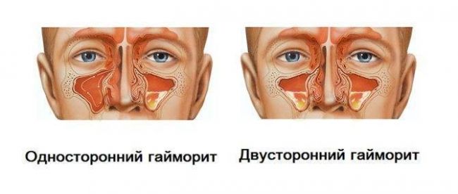 Что и где болит при гайморите: горло, глаза и уши