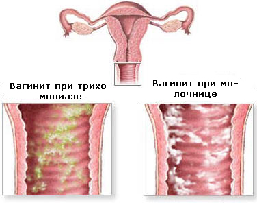 Вагинит (кольпит) – причины и симптомы. таблетки, капсулы, свечи и гели в лечении вагинита. чем лечить кольпит у женщин во время беременности