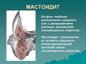 Киста сосцевидного отростка височной кости