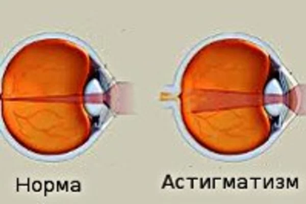 Современные методы лечения дальнозоркого астигматизма