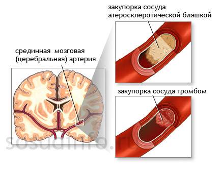 Очаги глиоза в головном мозге