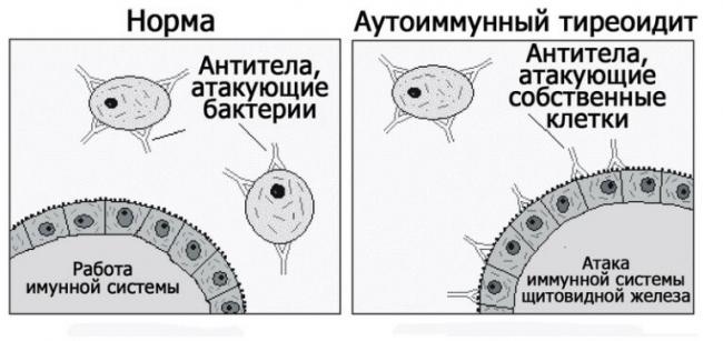 Симптомы заболеваний щитовидной железы