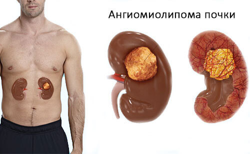 Чем опасна ангиомиолипома?