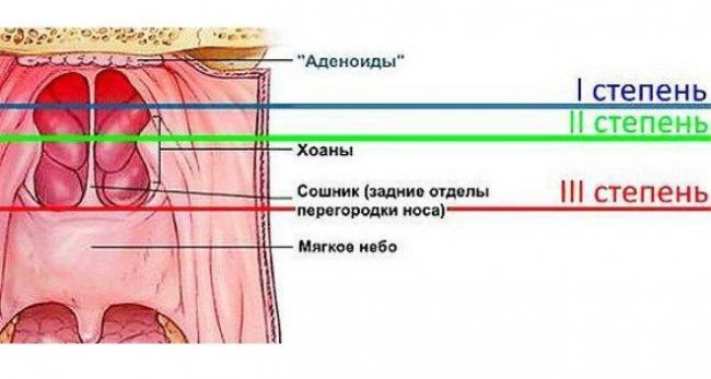 Как лечить кашель от аденоидов у ребенка?