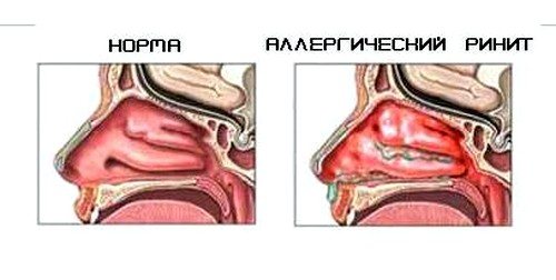Аллергический ринит у ребенка: симптомы и лечение