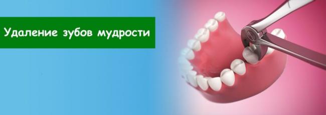 Семь проблем зубов мудрости - удалять или лечить?