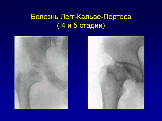 Болезнь пертеса – симптомы, лечение, формы, стадии, диагностика