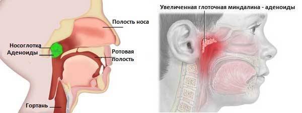 Симптомы и лечение аденоидита у детей: распознать и обезвредить!