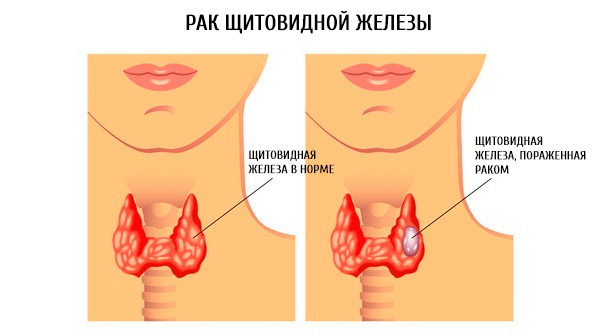 Узловой зоб щитовидной железы - лечение, симптомы, степени тяжести, народные средства в лечении заболевания - docdoc.ru