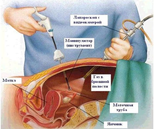 Внематочная беременность: причины, признаки и многое другое