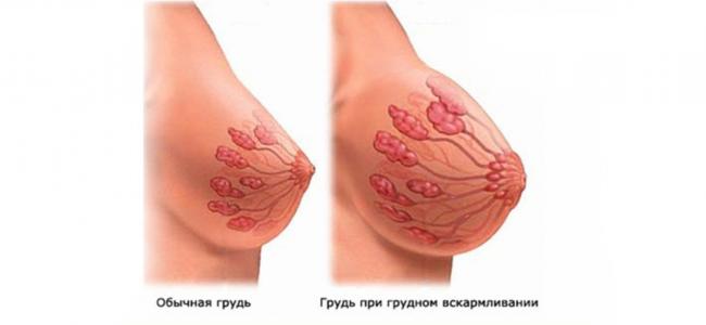 Острый мастит (грудница)