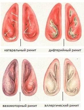 Лечение вазомоторного ринита: как лечить у взрослых в домашних условиях