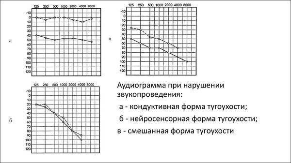 Сенсоневральная тугоухость 3 степени – дают ли инвалидность, какую группу
