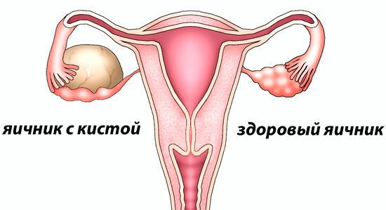 Функциональная киста яичника: симптомы и лечение