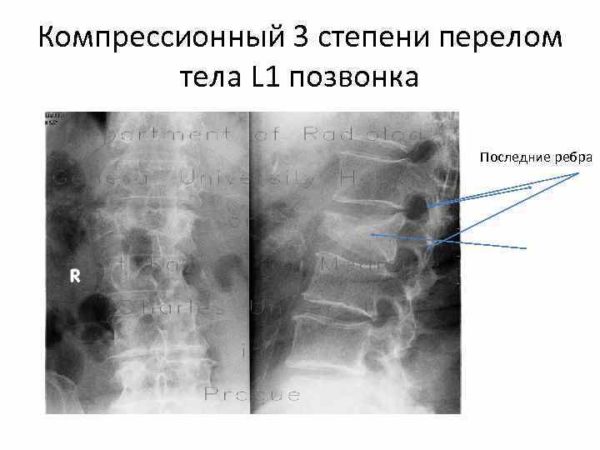 Компрессионный перелом позвоночника: что это такое, симптомы, лечение, последствия перелома позвонков
