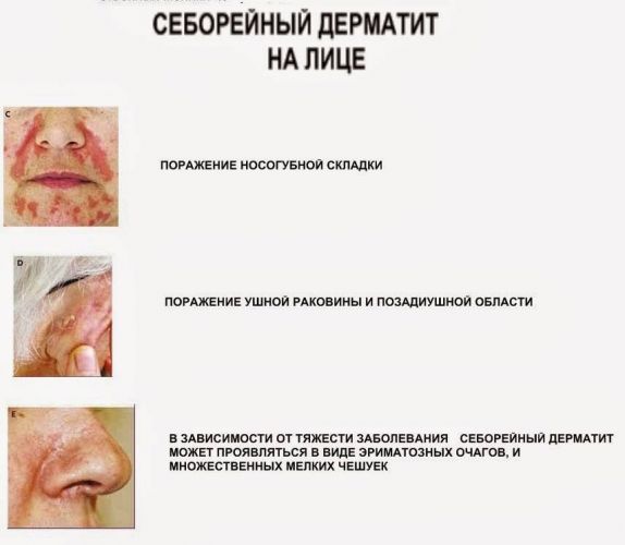 Себорейный дерматит заразен или нет